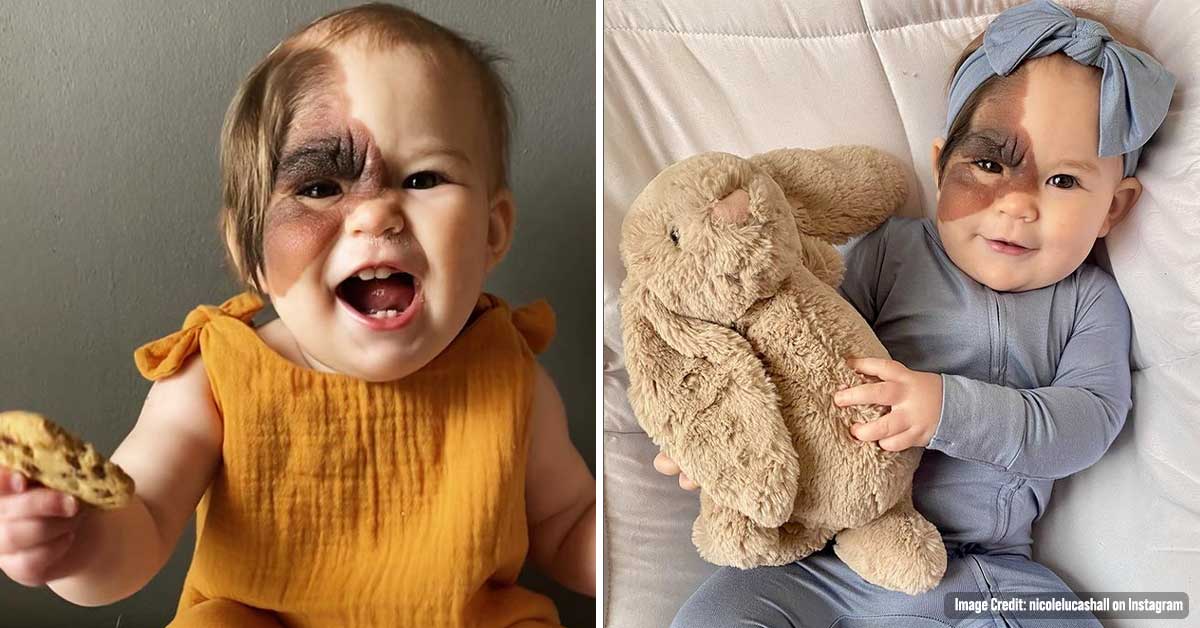 Mom Shared Her Daughter’s Unique Birthmark and Gathered 300k Followers on Social Media