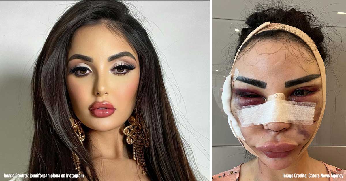 Model who Spent $600k to Look Like Kim Kardashian Is Now Spending $120k to Revert to Her Natural Looks