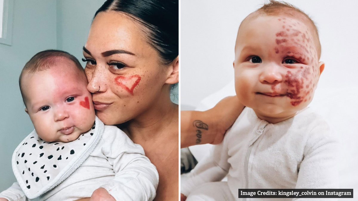 Mother slams trolls who call her a ‘Monster’ because she lasers her baby’s large birthmark