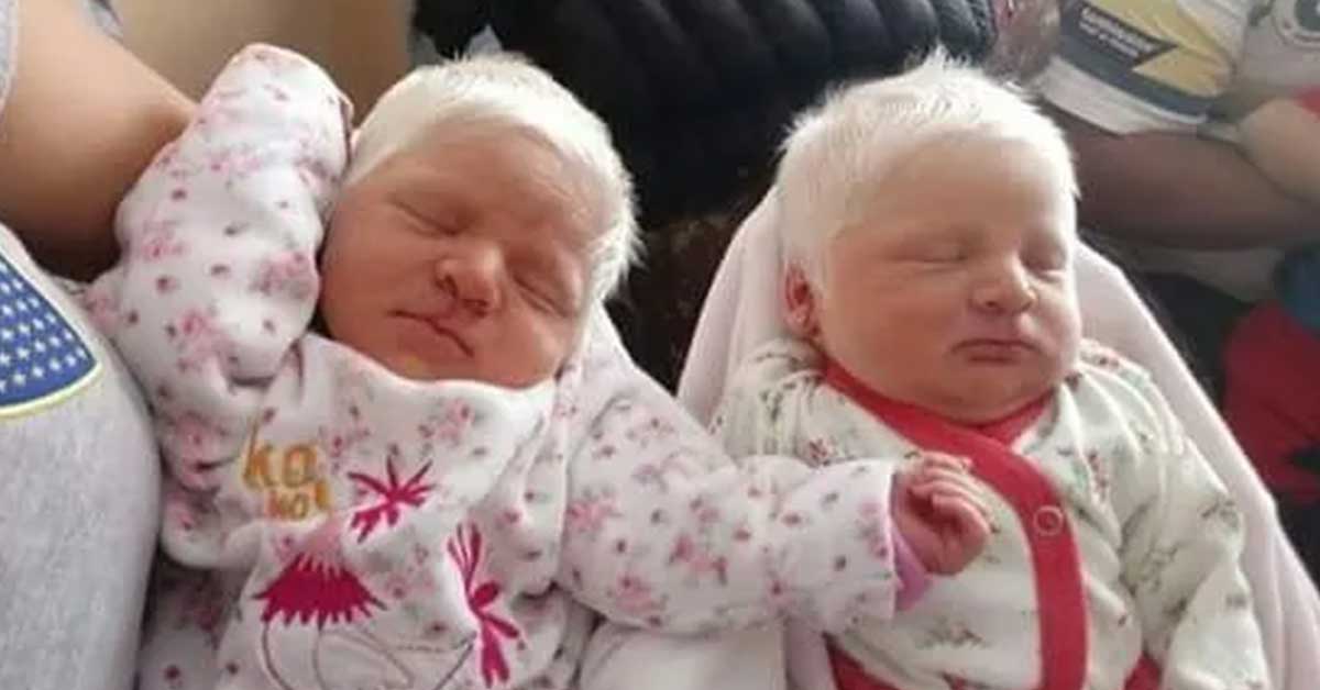 Catalina and Virginia, the First Ever Albino Twins from Argentina with Snow-White Hair
