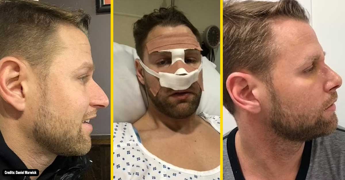 British Man, 34, Got a Nose Job because he Hated his Profile and Said It was the BEST Decision he’s Ever Made