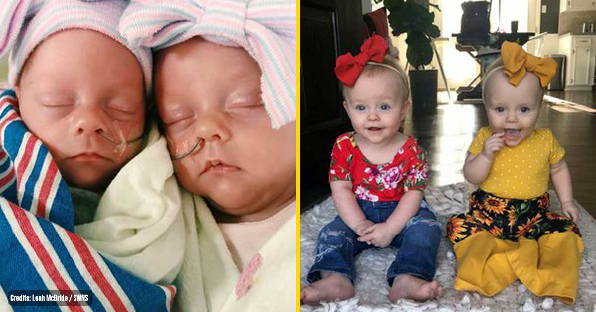 Unborn baby Saves her Twin Sister’s Life by Sending out Distress signals in the Womb