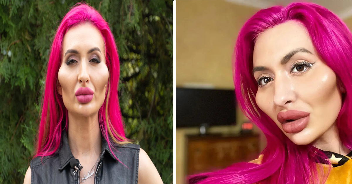 Model with ‘World’s Biggest Cheeks’ Stunned Followers with Pre-Surgery Photo