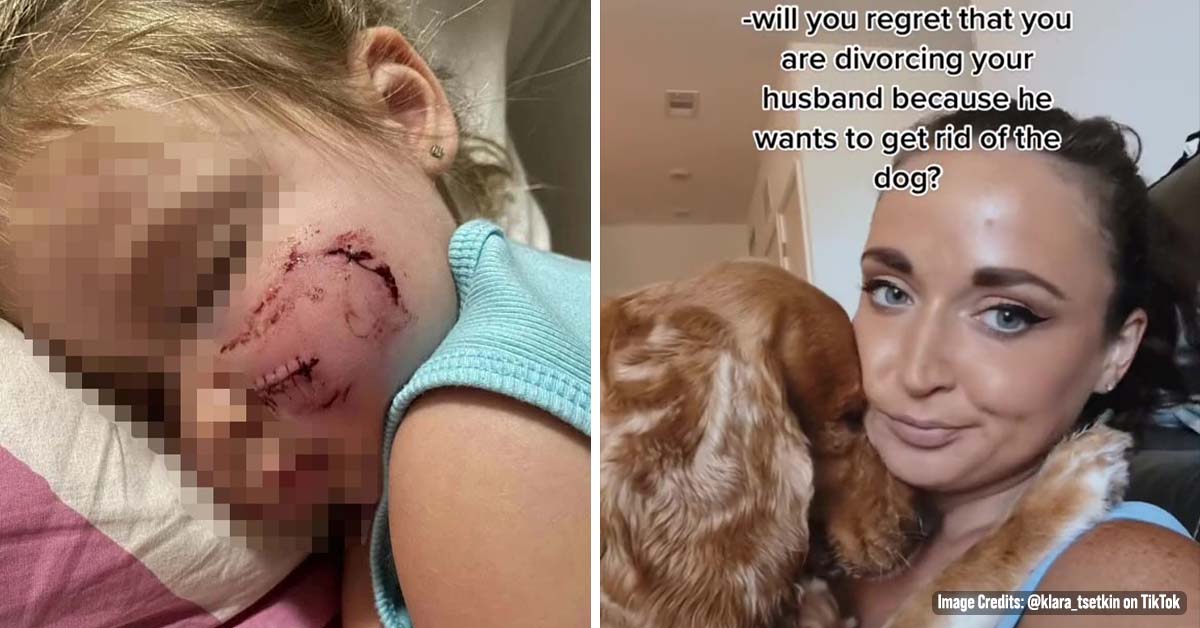 Mum Slammed for Keeping Pet Dog After It Mauled 3-Year-Old Daughter’s Face Leaving Her Scarred