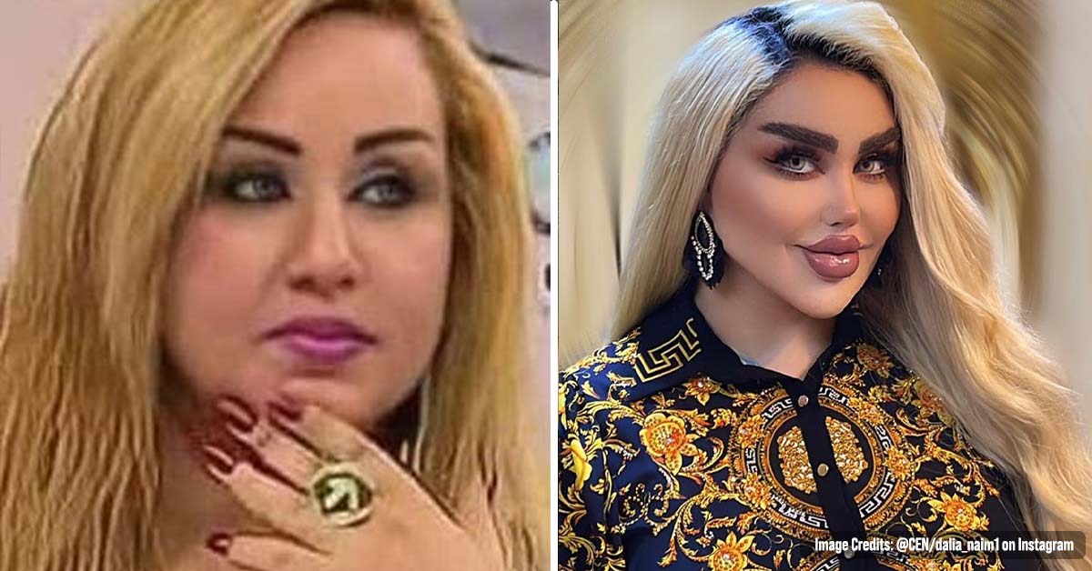 Woman Says She’s had 43 Cosmetic Procedures to become a Barbie Doll, but People Tell Her She Looks like a Zombie