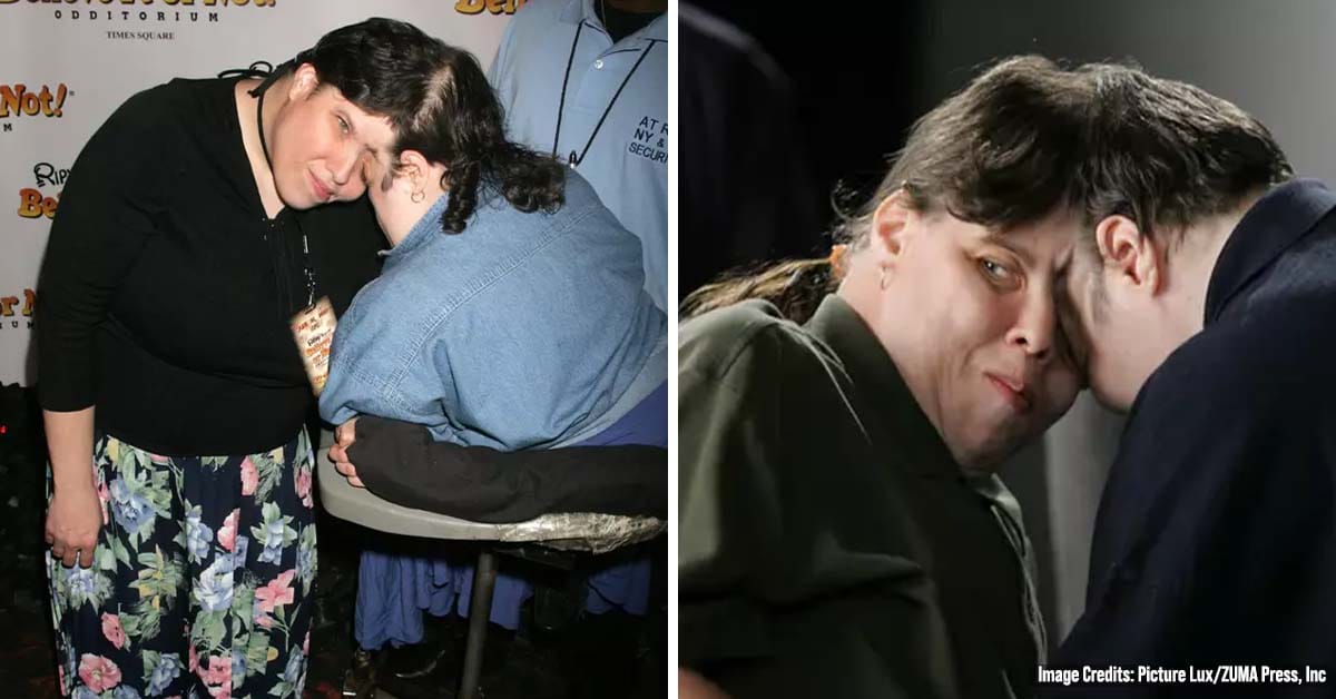 Conjoined Twin Explains What Happens During Sister’s Intimate Moments With Boyfriends