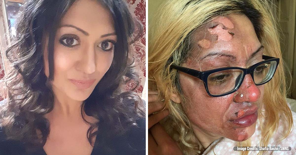 Mother Left in ‘Absolute Agony’ After Viral TikTok Hack Left Skin Peeling from her Face