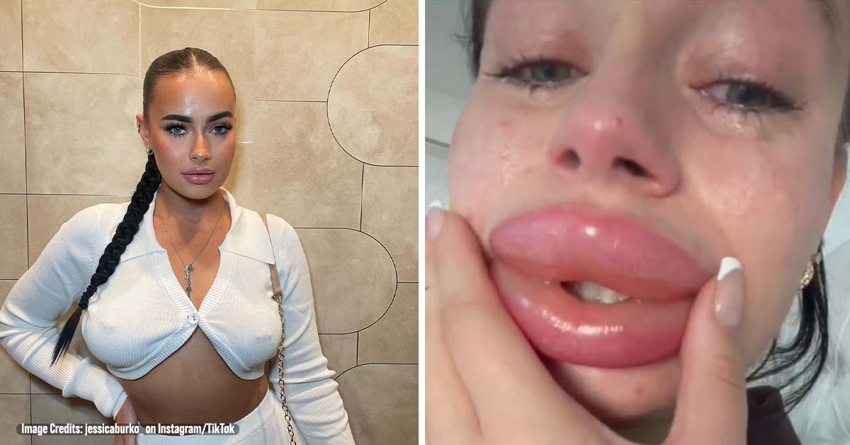 Woman, 27, Issues Warning About Giveaway Beauty Treatments After She was Left with Botched Lips