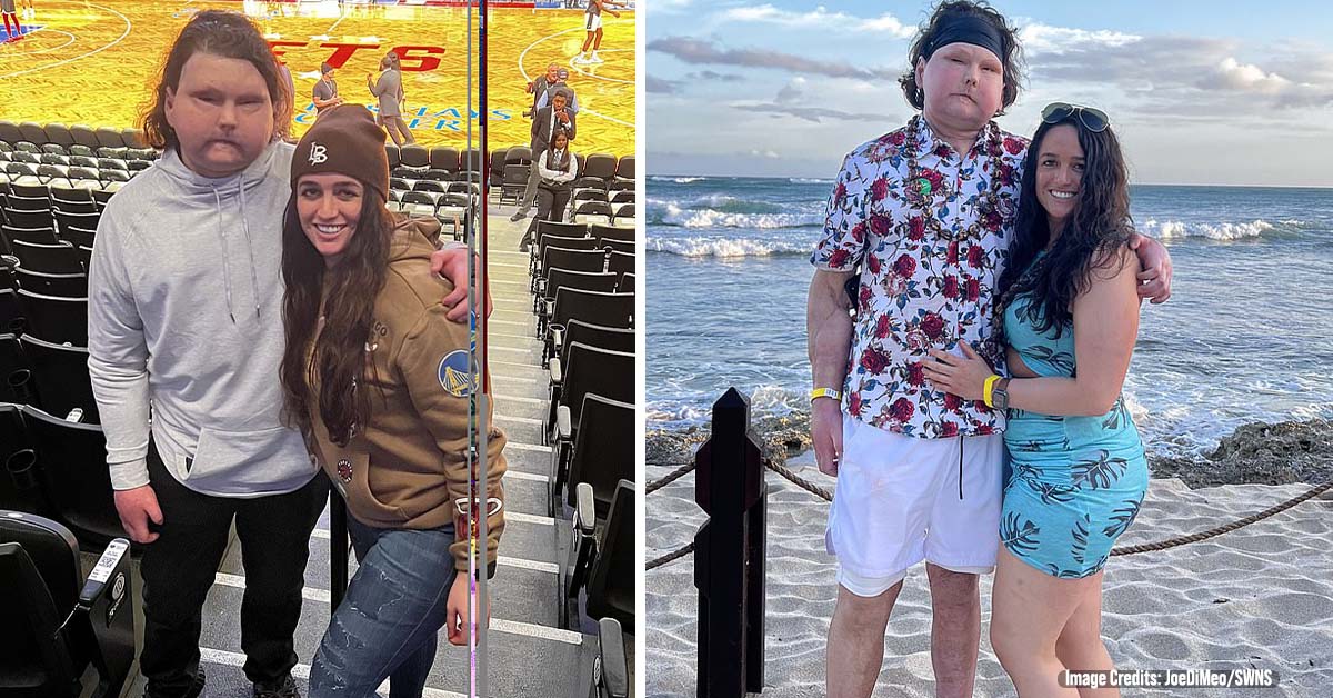 Man Who Had World’s First Successful Face and Double Hand Transplant Finds Love