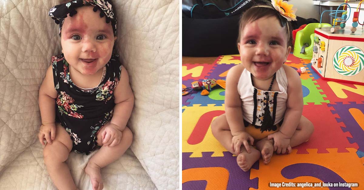 Baby With Red Birthmark Called ‘Hideous’ And ‘Defective’, But Wait Till You See This Beautiful Kid Now